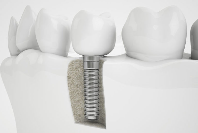 bone graft for dental implants