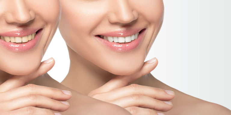 teeth whitening patient smiling after procedure