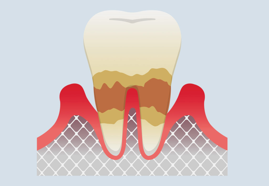 Advance Periodontitis