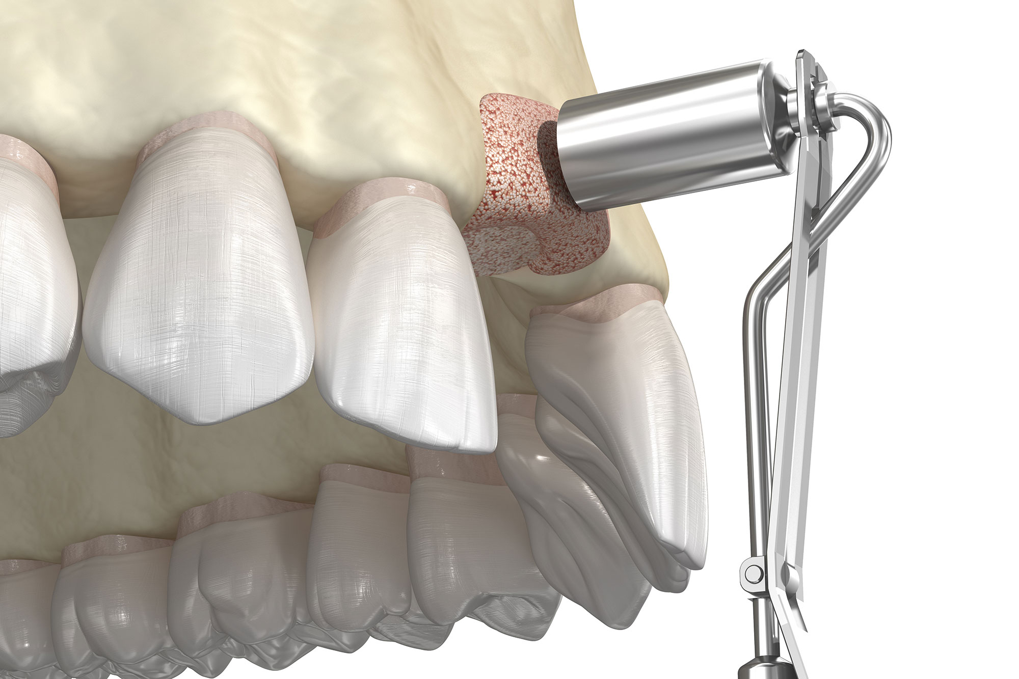 Guided Tissue Regeneration Bissell Periodontist Chester New Jersey