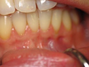 Before and after dental photo Bissell Periodontist Chester New Jersey
