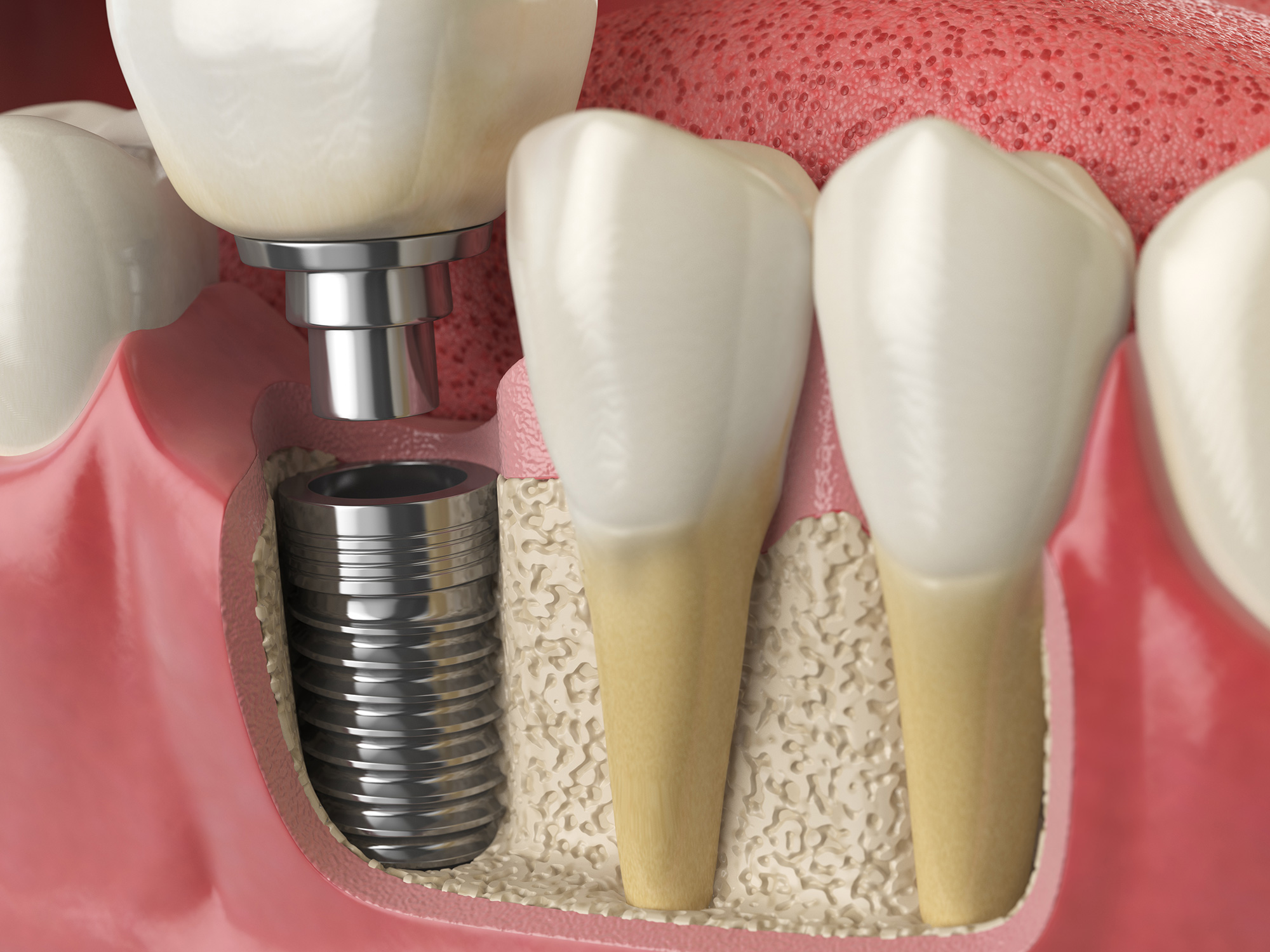 Dental implants Bissell Periodontist Chester New Jersey