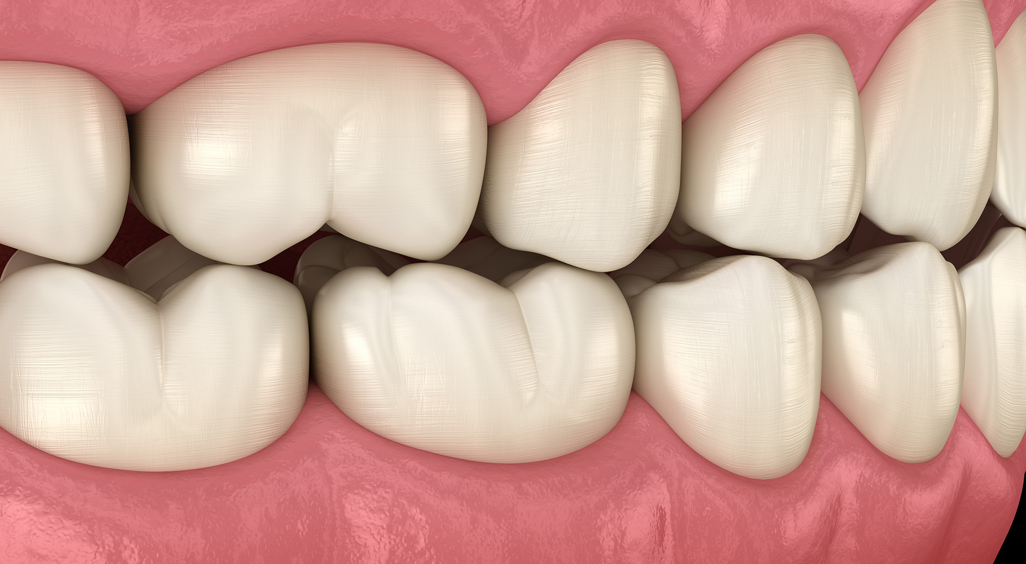 Occlusal Adjustment Bissell Periodontist Chester New Jersey