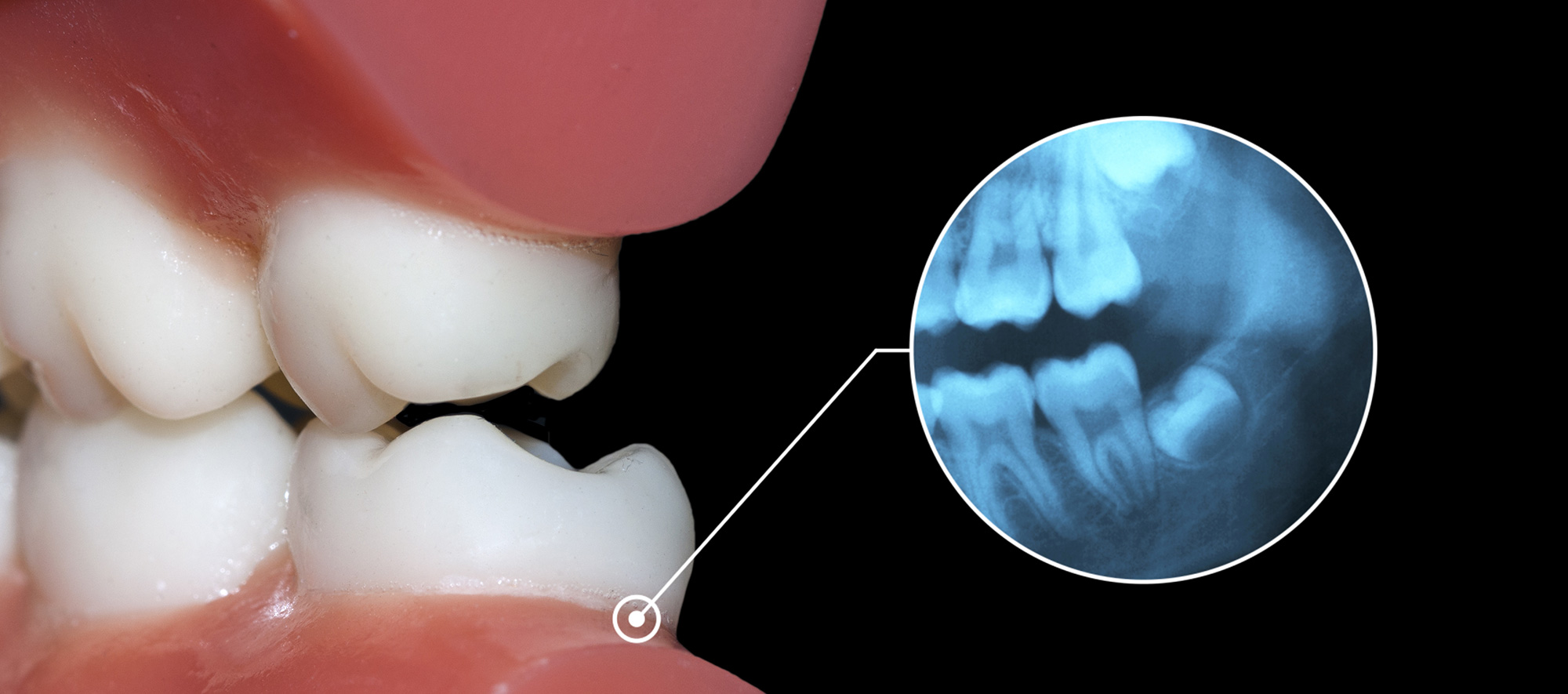 Occlusal Adjustment Bissell Periodontist Chester New Jersey