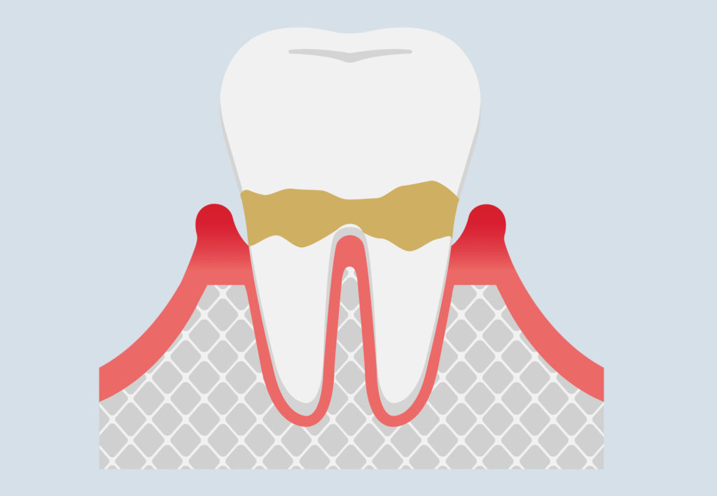 Periodontitis