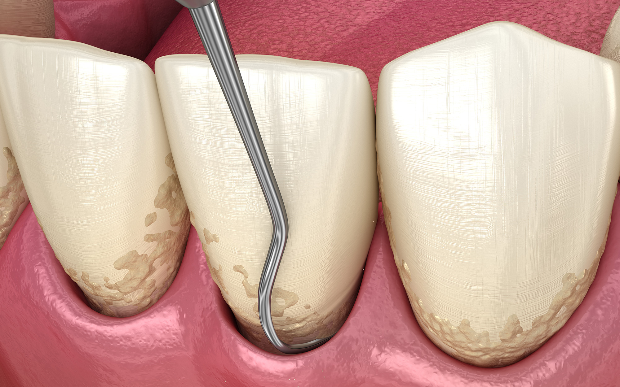 Scaling and Root Planing Bissell Periodontist Chester New Jersey