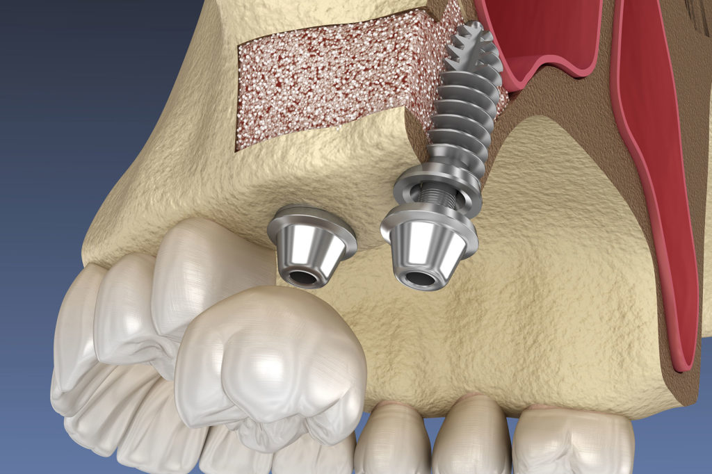 Sinus Lift in Chester, NJ