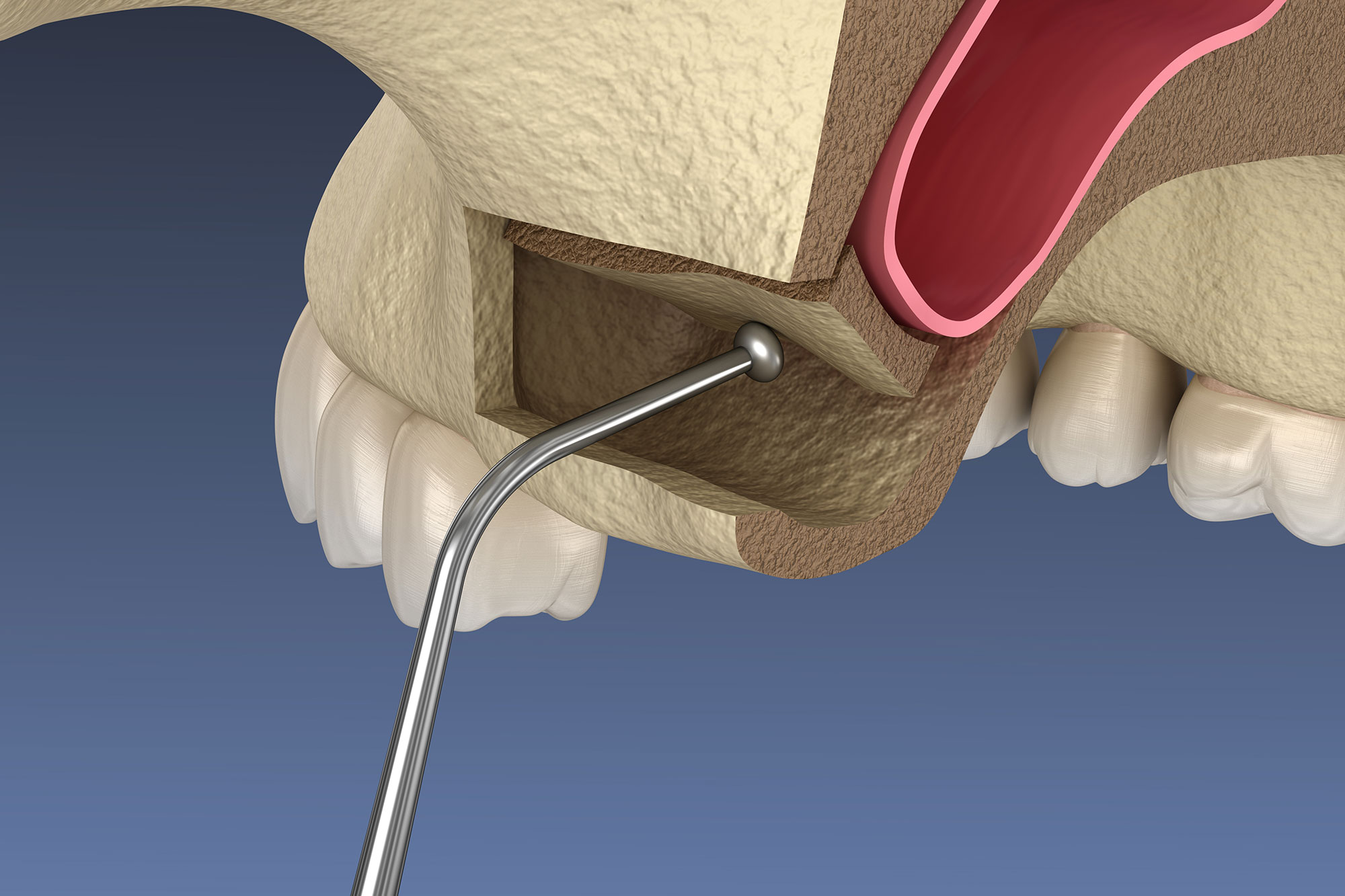 Sinus Lift in Chester, NJ